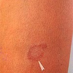 Hanseníase detectada em fase inicial tem cura - Fotos:Ascom/SMS