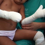Cresce o número de pacientes vítimas de fogos internados no Huse - A dona de casa Edneide da Silva